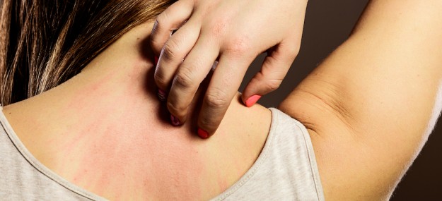 dermatitis dermatitis